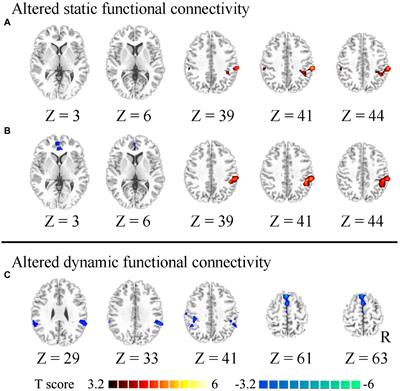 The influence of high worry on static and dynamic insular functional connectivity